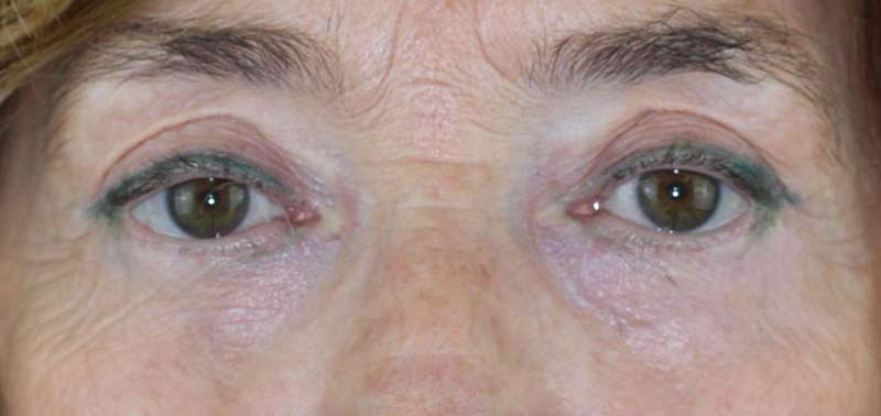 Caso clínico de blefaroplastia