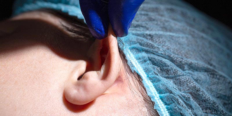 otoplastia-cicatriz