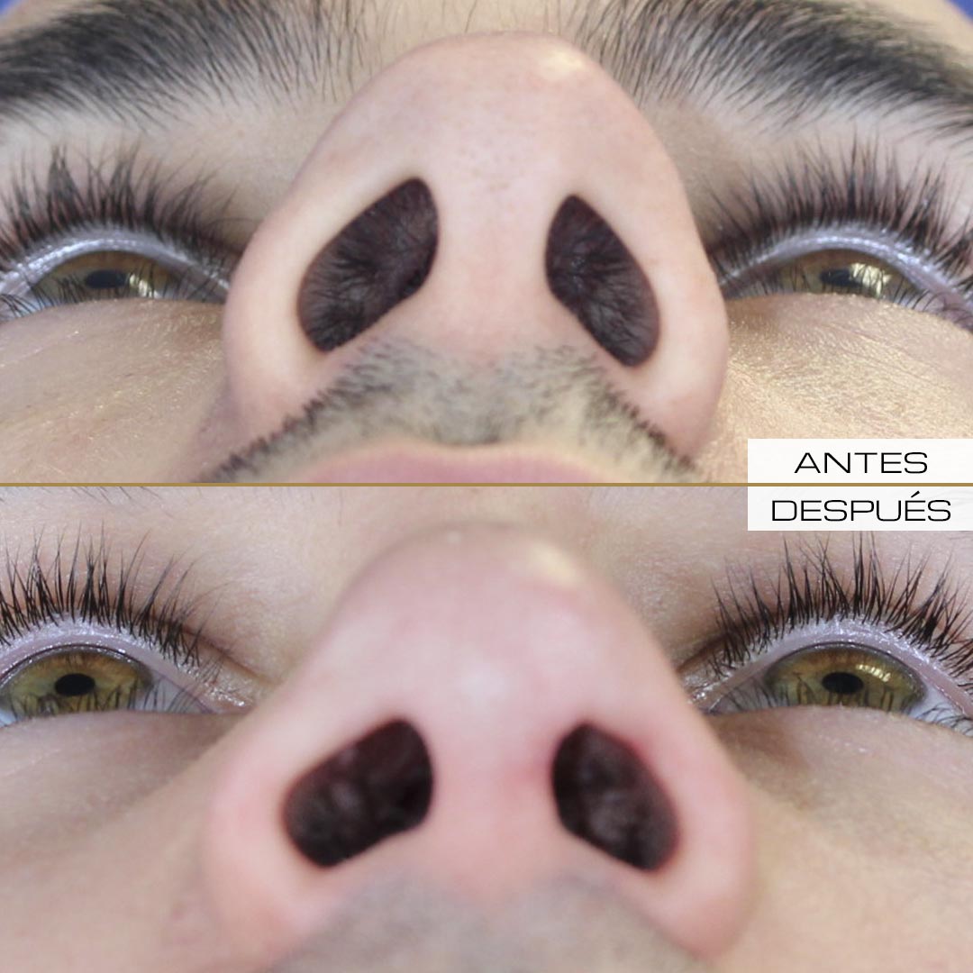 Caso clínico de rinoplastia